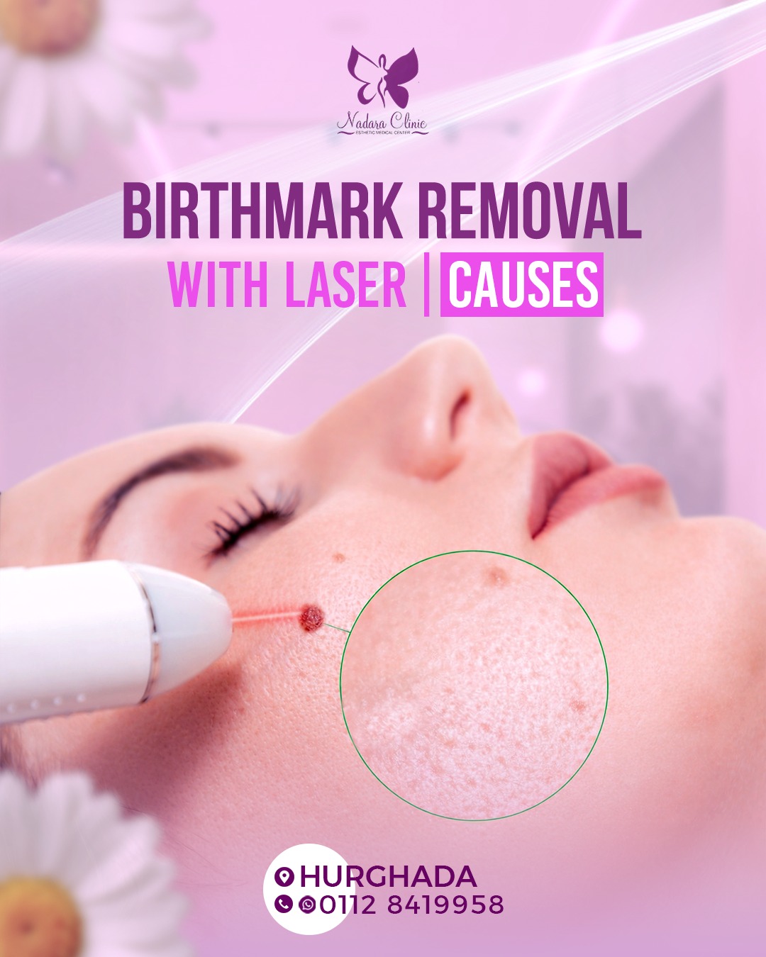 Laser treatment for birthmarks and their causes in Hurghada
